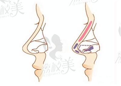 荔枝美：假体隆鼻