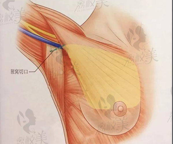 假体隆胸腋下切口