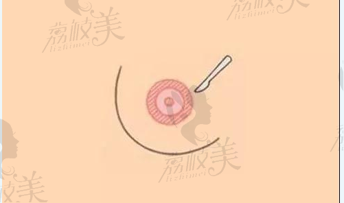 假体隆胸乳晕处切口
