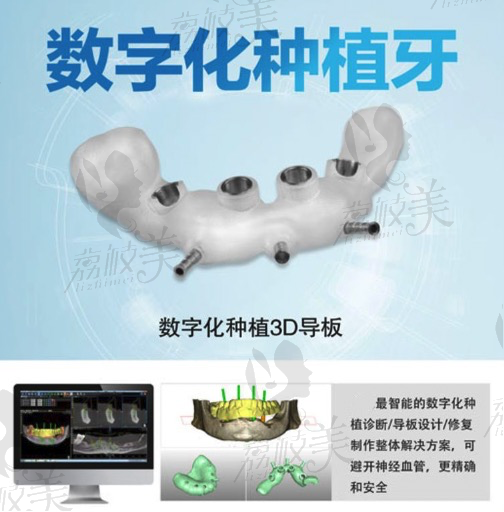 长沙美奥口腔赵鑫院长3D数字化导板种植牙技术优势