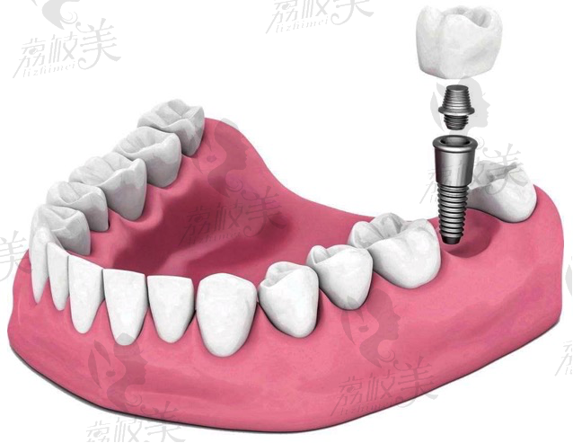 长沙美奥口腔种植牙技术怎么样？