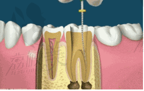 根管治疗杀神经