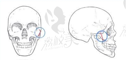 I型截骨