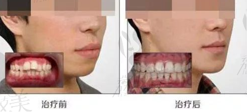 牙齿前突