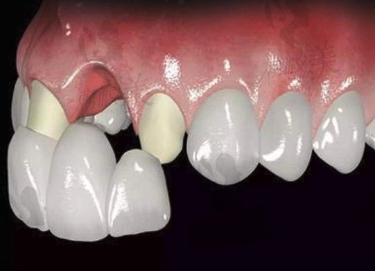 固定假牙需磨小相临的两颗牙，损坏了天然牙齿。