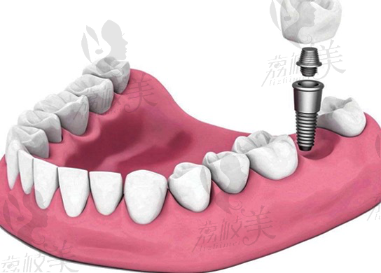 种植牙可以跟真牙相媲美的一种牙齿修复方式