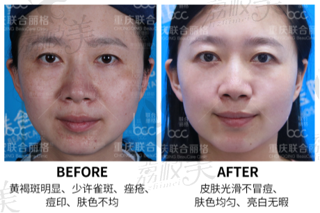 重庆联合丽格bcc全能皮肤卡斑点类联合治疗