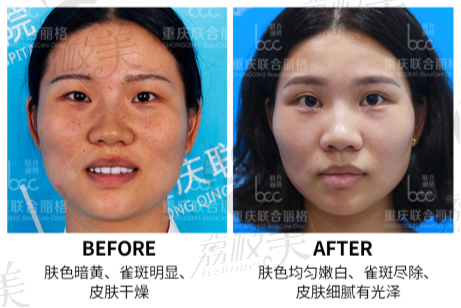 重庆联合丽格bcc全能皮肤卡斑点类联合治疗