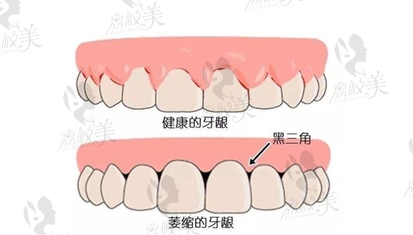 牙龈萎缩