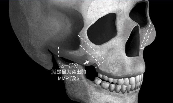 韩国颧骨缩小术