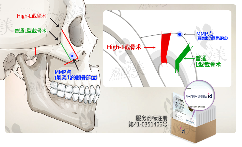 韓國(guó)id醫(yī)院顴骨內(nèi)推