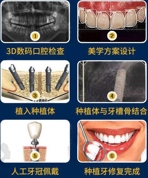 长沙牙祖口腔（井湾子店）陆益兰院长微创种植牙的诊疗流程