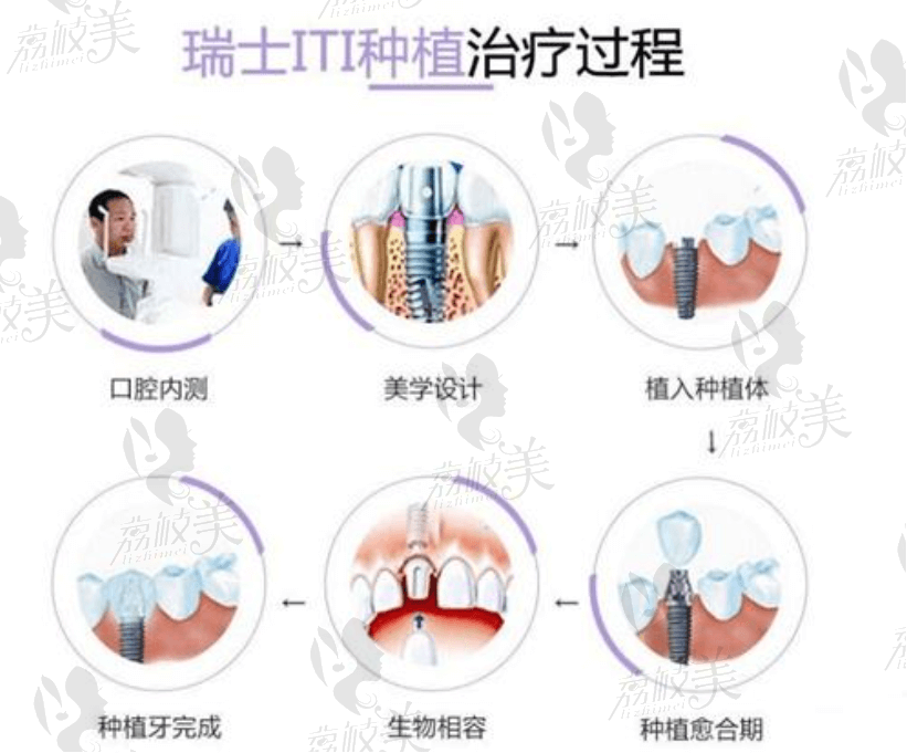 瑞士ITI的亲水种植体