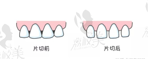 牙齿片切前后对比