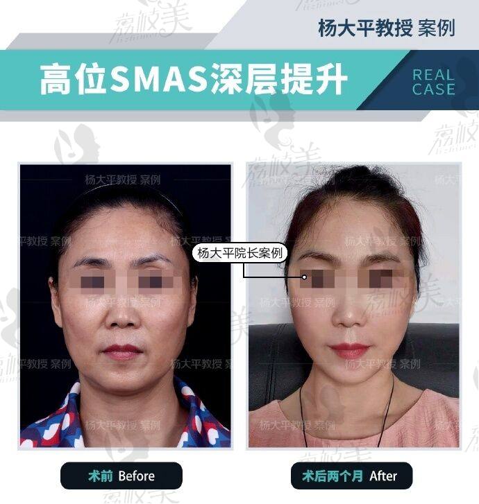 联合丽格杨大平院长—面部抵抗老龄化提升术案例!