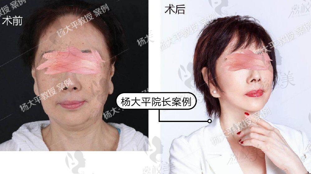 联合丽格杨大平院长—面部抵抗老龄化提升术案例!
