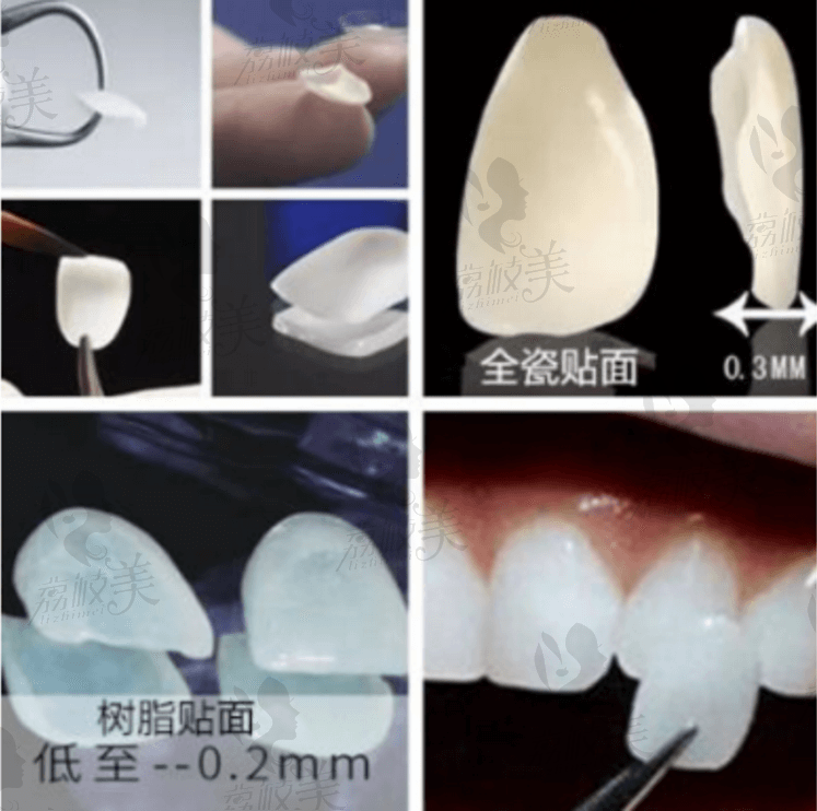 牙贴面种类