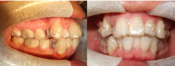矫正牙齿佩戴隐适美矫正器