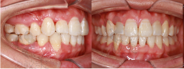 矫正牙齿结束