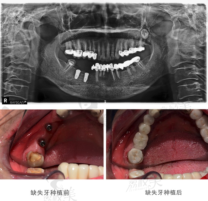 北京中诺口腔医院李时顺主任微创种植牙案例