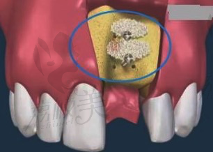 种植牙植骨粉成功率高吗？
