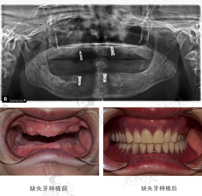 上海泰康拜博口腔医院的黎强院长的种植牙案例