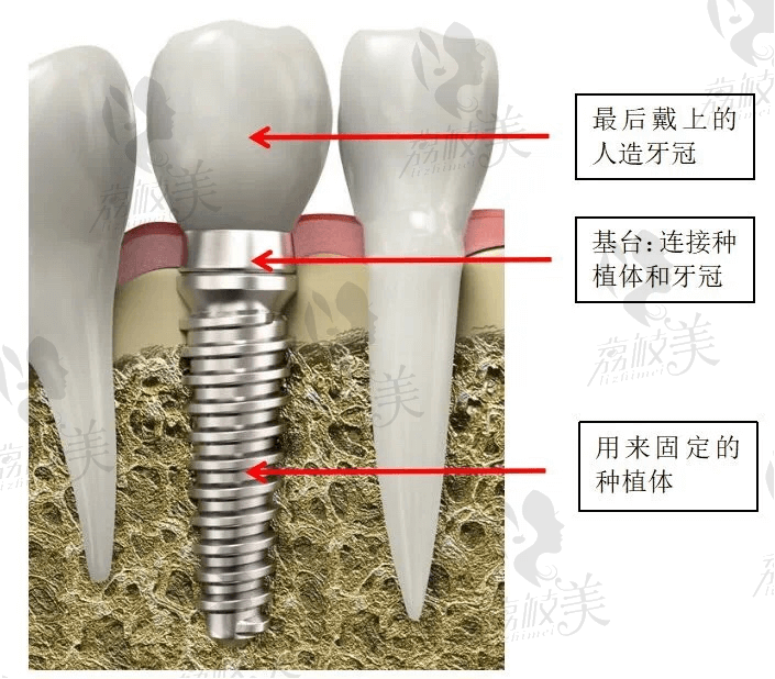 厦大港悦齿科韩国登腾种植体  单颗种植牙