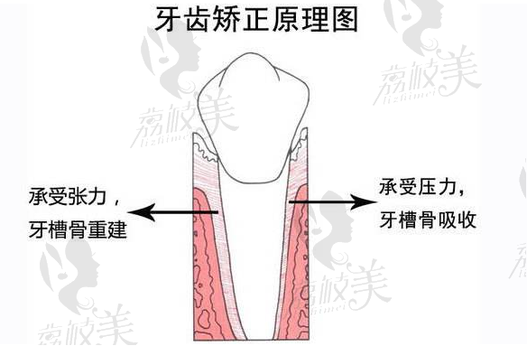 牙齿矫正原理