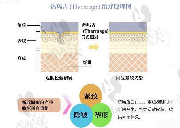 热玛吉原理图