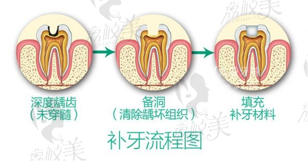 补牙流程图