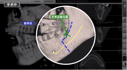 導(dǎo)航雙鄂手術(shù)