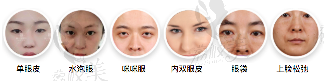 GS眼综合可以矫正的六种眼型