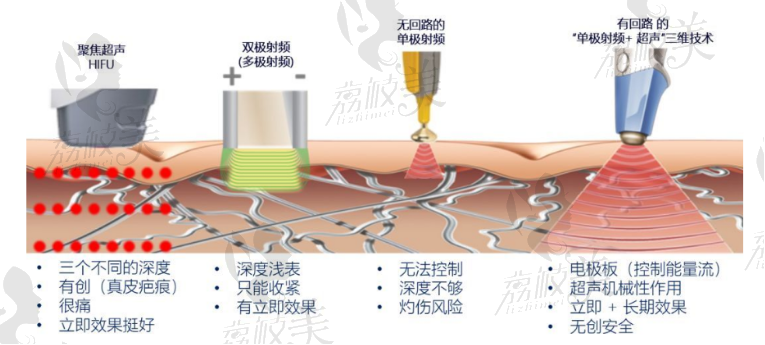 北京领医四代BTLultra360胶原枪抵抗老龄化效果