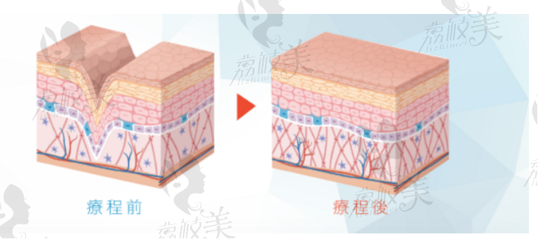 北京领医四代BTLultra360胶原枪抵抗老龄化效果