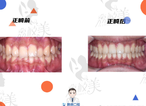 上海臻威口腔魏东牙齿不齐矫正