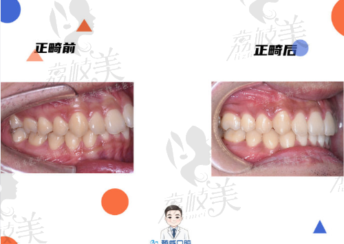 上海臻威口腔魏东牙齿矫正侧面