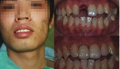 西安中诺口腔刘光茂主任门牙种植牙修复案例