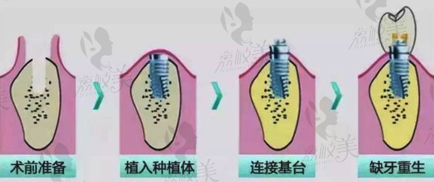 种植牙的过程