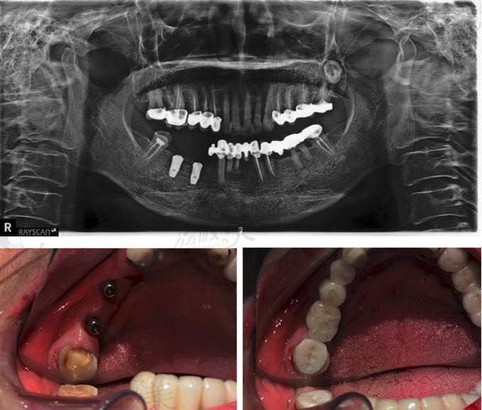 北京中诺口腔立得用种植牙案例分享