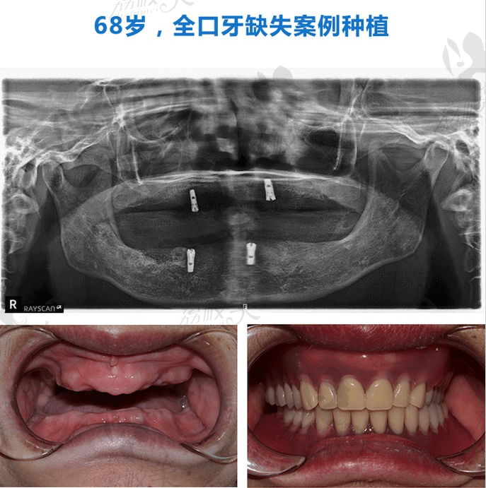 韩国登腾全口种植牙案例