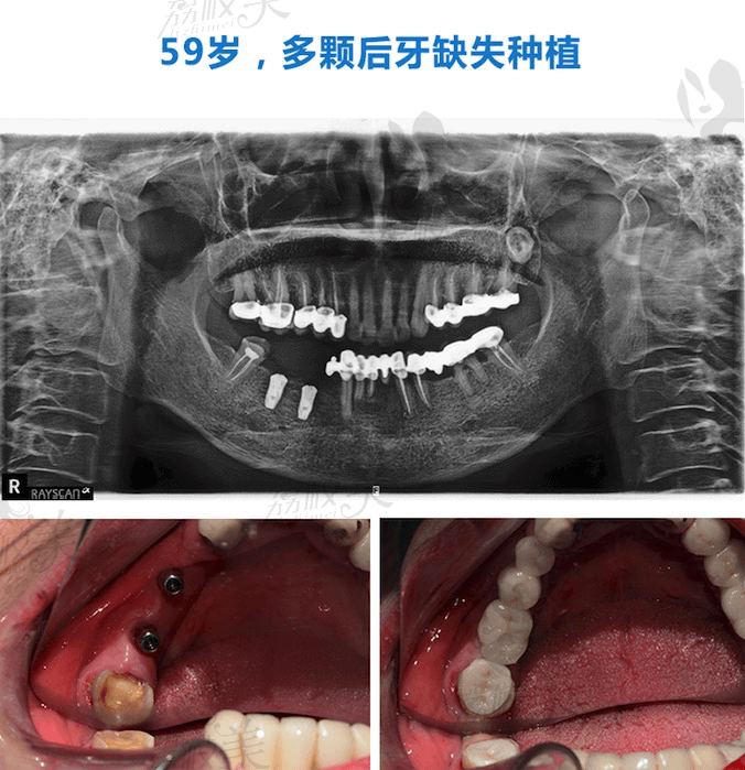 韩国奥齿泰多颗缺失种植牙案例