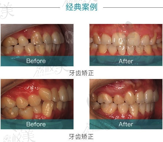 宁波恩吉口腔阎妍主任隐适美隐形矫正案例