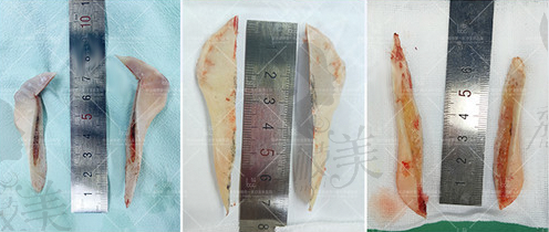 何照华教授的长曲线下颌角截骨术截取的骨头