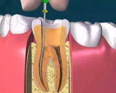 根管治疗后还能做牙齿矫正吗？