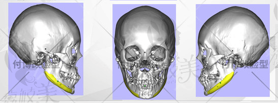 3D打印下颌角修复模型电脑图