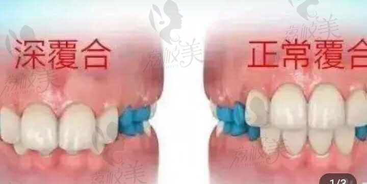 福州格莱美口腔医师王利勤深覆盖