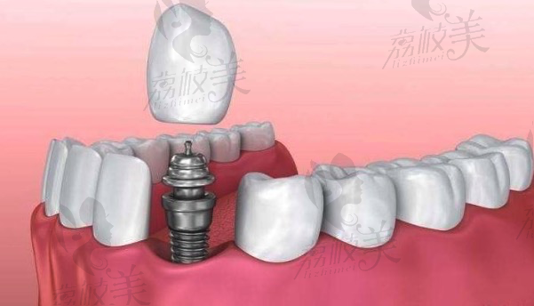 做种植牙的全过程