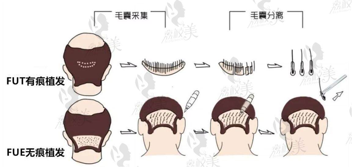 传统的植发技术有两种：FUT和FUE两种