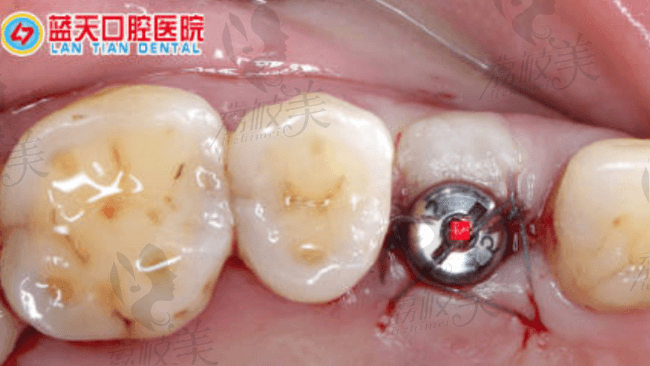 种植体植入状况