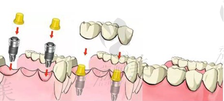种植牙的步骤